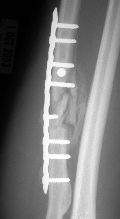 Radius & Ulna, Shaft:  Synthes LCP (Implant 261)
